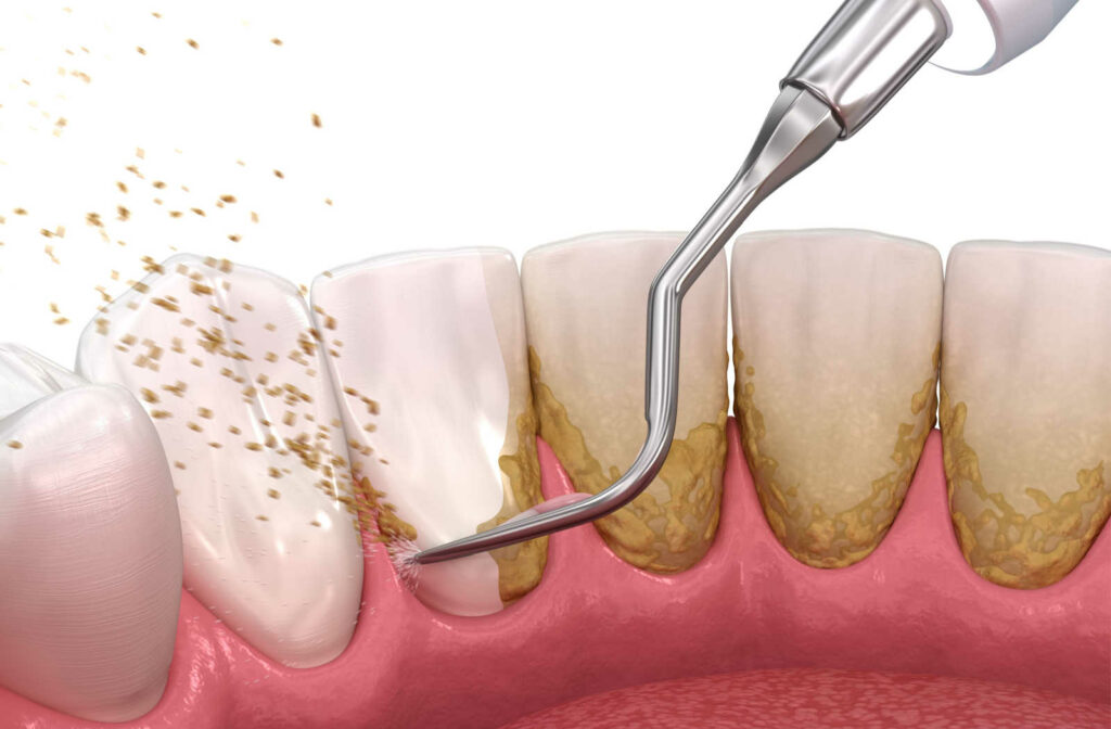 A dental cleaning process is demonstrated here to show how a dentist uses the scaling technique to free the teeth from plaque and tartar.